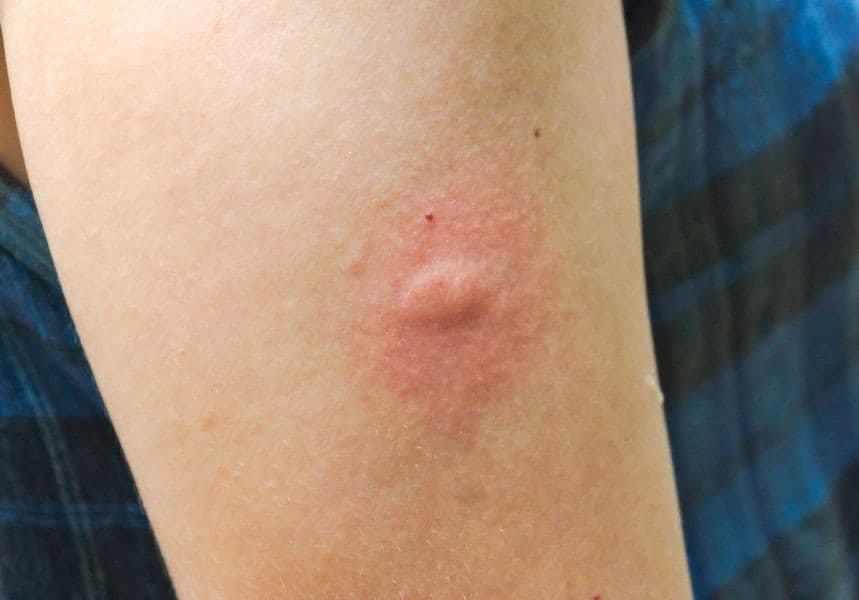 樟腦油功效其中一個是驅蚊蟲